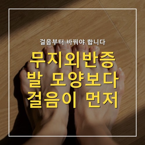 무지외반증, 걸음에 미치는 영향과 집에서 하는 교정 운동 3가지