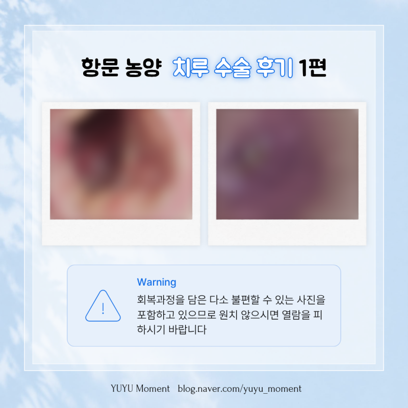 [사진후기] 복잡형치루 항문 농양 | 치루근본절제술+배농술+쥐젖제거 회복과정 1편