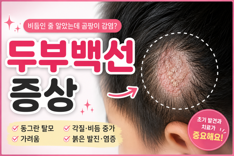 두부 백선, 방치하면 흉터성 탈모까지? 증상과 치료법 완벽 정리