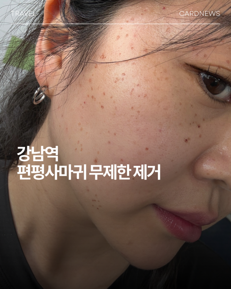 강남편평사마귀성지 만족도가 높았던 무제한 제거 후기