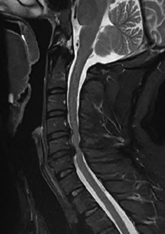 목디스크 MRI 비용, 찍은 후 대처법