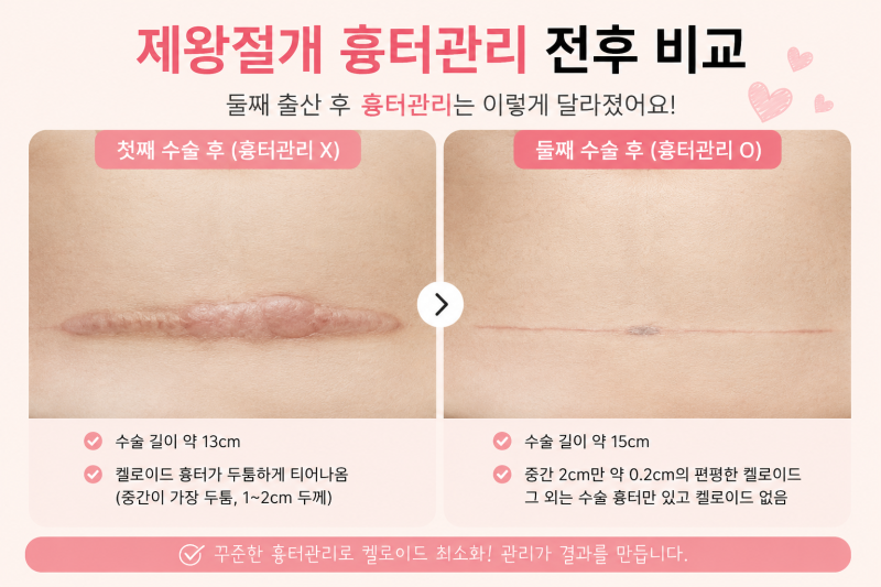 제왕절개 흉터 관리법: 켈로이드 주사 시기 및 첫째·둘째 리얼 비교 후기