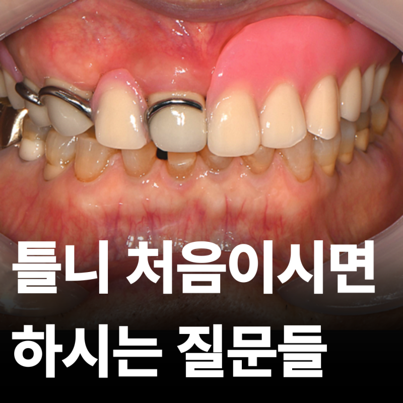 틀니 처음 하신다면, 종류 관리법 자주 묻는 질문