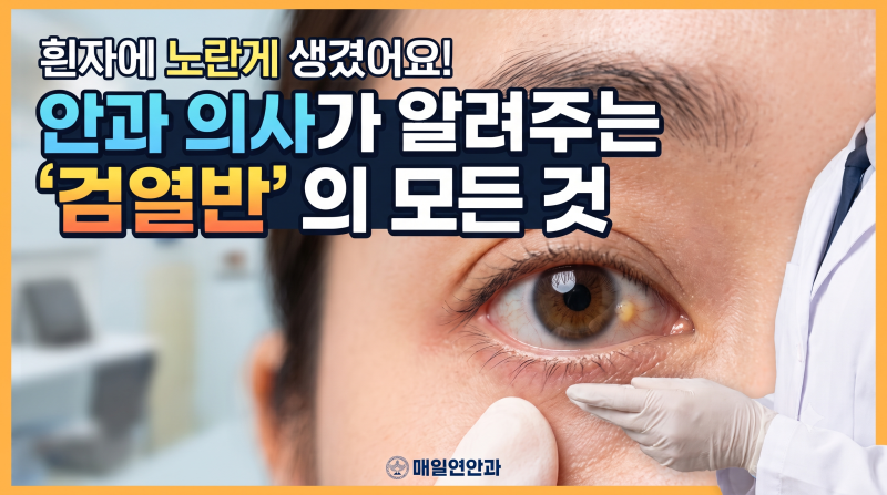 흰자에 노란게 생겼어요! 안과 의사가 알려주는 '검열반'의 모든 것