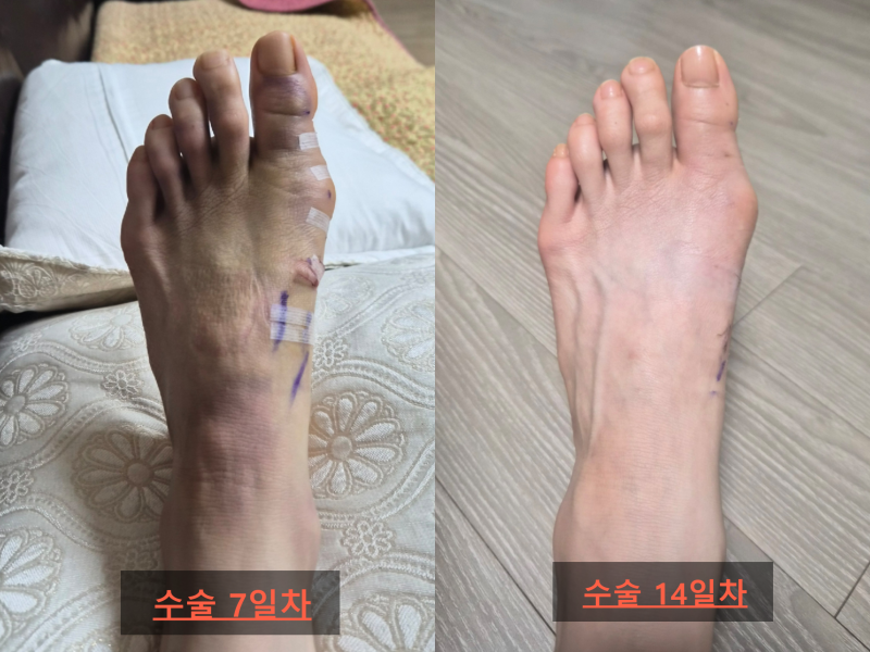[무지외반증 수술 후기]14일차(2주 후)-4편★최소침습수술(MICA) 추천할까? / 무지외반증 운동방....