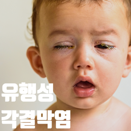 유행성 각결막염 증상, 원인 치료 예방, 아폴로눈병, 알레르기 구별