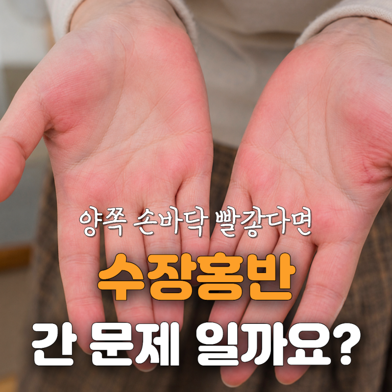 손 씻고 나와도 손바닥이 계속 빨갛다면, 수장홍반일 수 있어요