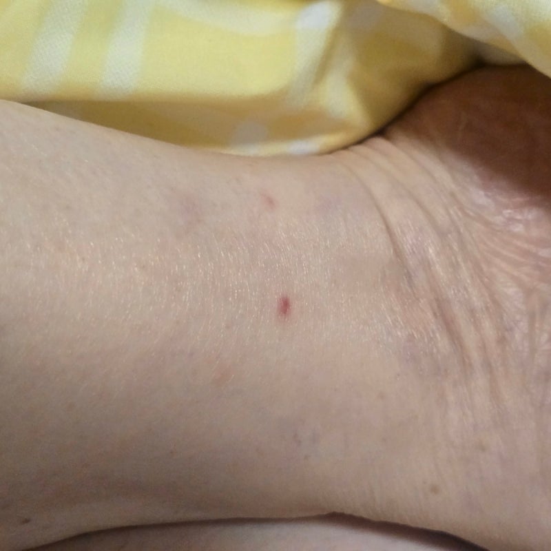 붉은반점 원인, 다리 피부에 갑자기 생겼을 때 확인할 것