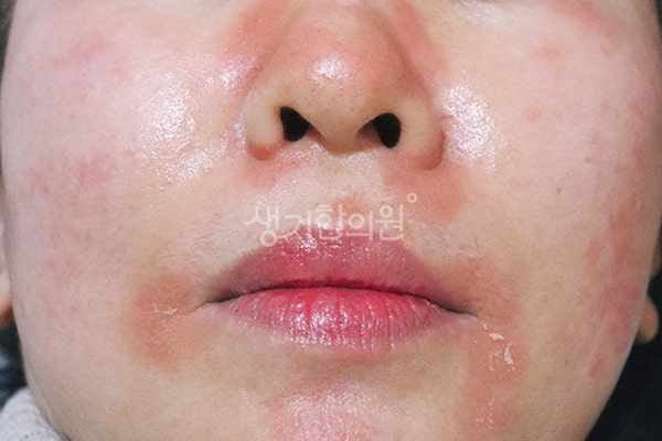지루성피부염 식습관 관리 기름진 음식과 밀가루가 염증의 원인과 관리법