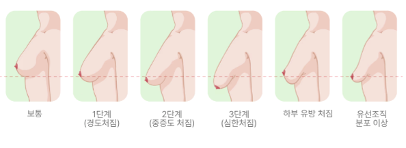 처진가슴수술, 운동/리프팅/지방이식으로 개선할 수 있을까?<3편의 논문으로 답변해 드립니....
