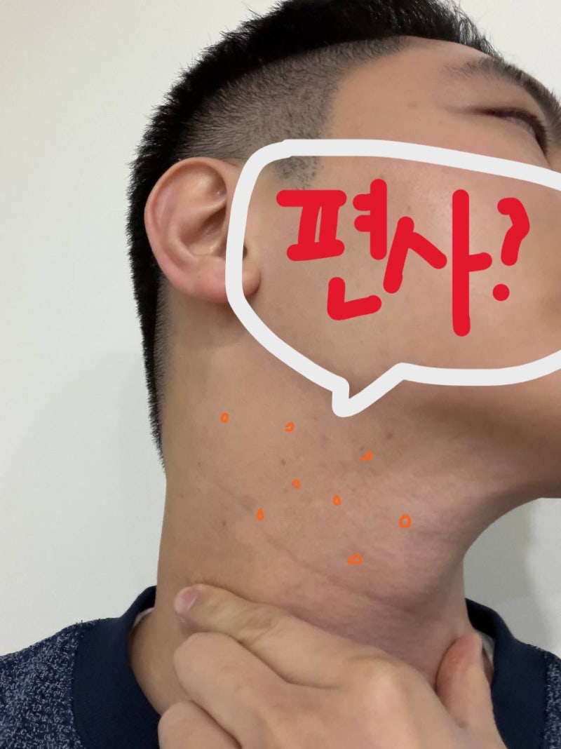 천안편평사마귀제거 피부과, 자칫하면 돈만 버립니다