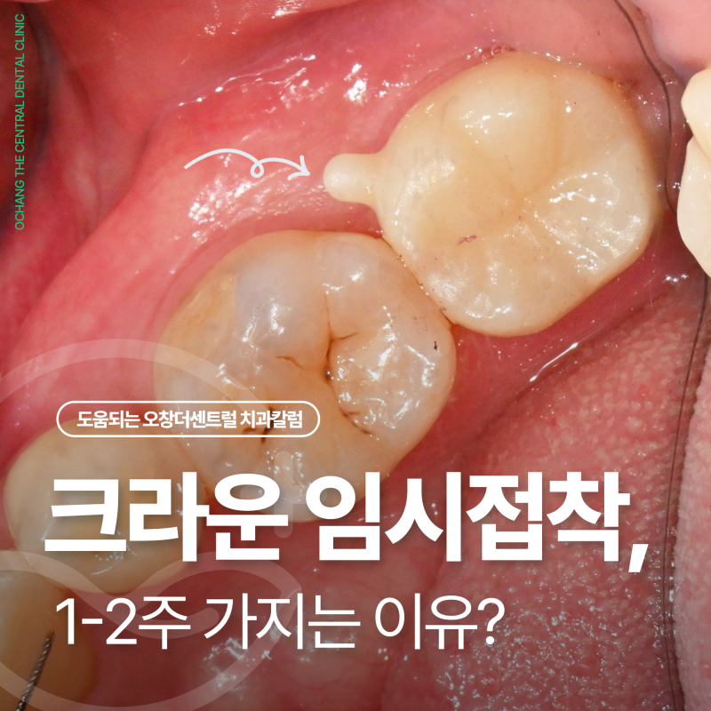 크라운 치료, 최종 접착 전 확인할 5가지