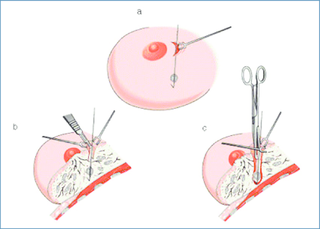 군집성 미세석회화 조직검사, 수술? 맘모톰? 정확한 방법은