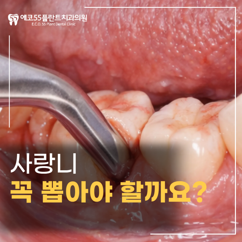 아산 사랑니 발치, 매복사랑니 꼭 대학병원에서 뽑아야 할까요?