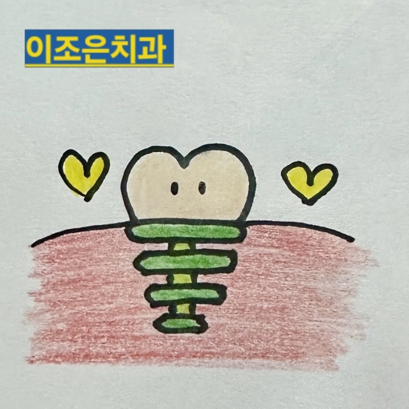 부평임플란트 임플란트 가격 저렴한 곳이 좋을까요?