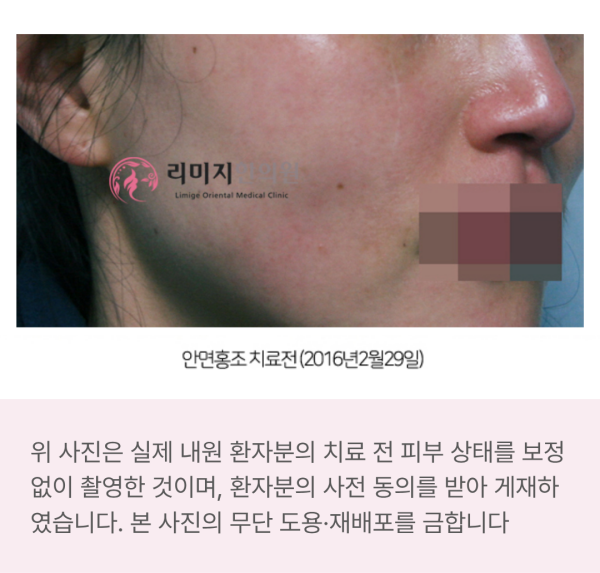 감정홍조 치료, 두근거림과 얼굴 열감으로 외출까지 꺼려진다면