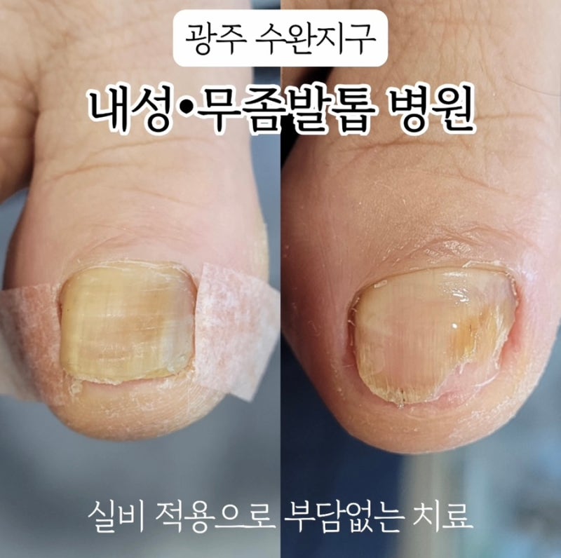 광주 내성 무좀발톱 병원 수완지구 부담 없이 치료받은 후기