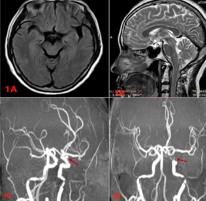 뇌MRI vs 뇌MRA 차이, 이것만 알면 검사 걱정 끝! 머리 MRI 검사 전후 주의사항 까지