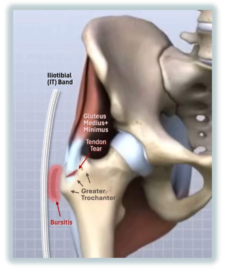 대전자 점액낭염(Greater Trochanteric Bursitis) 정의, 원인 및 치료법! [부전역 정형외과 질환 설명]