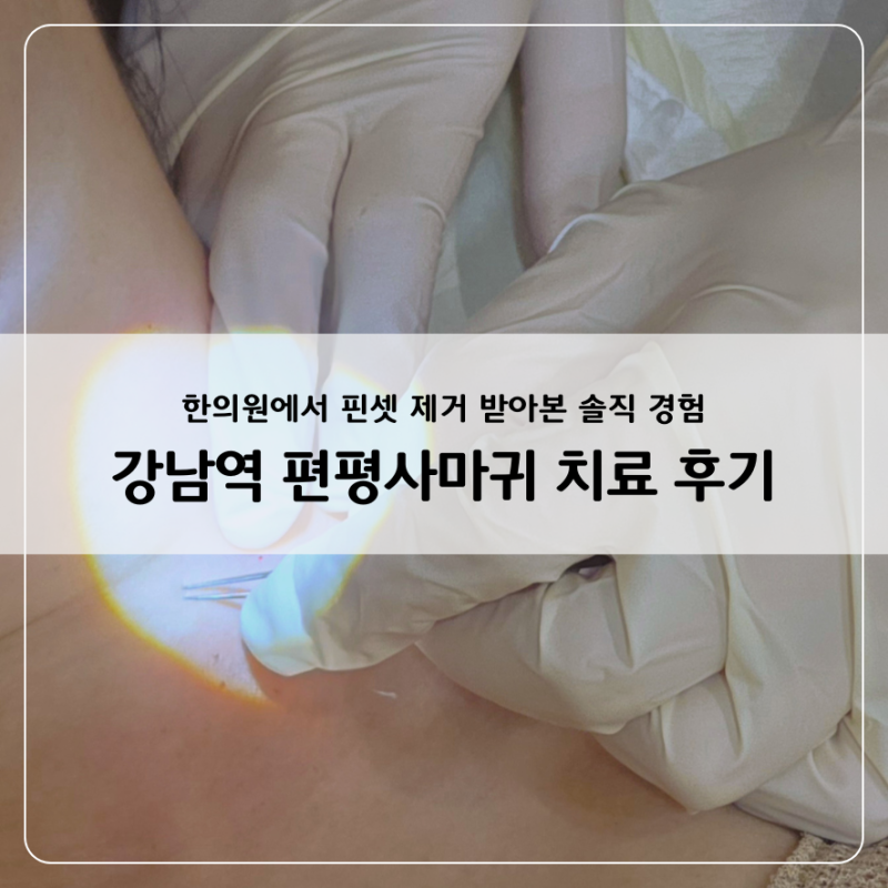 강남역 편평사마귀 치료 후기, 핀셋 제거 받아본 솔직 경험