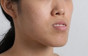 주걱턱양악수술 섣부르게 하고 후회하기 전에 꼭 확인하세요