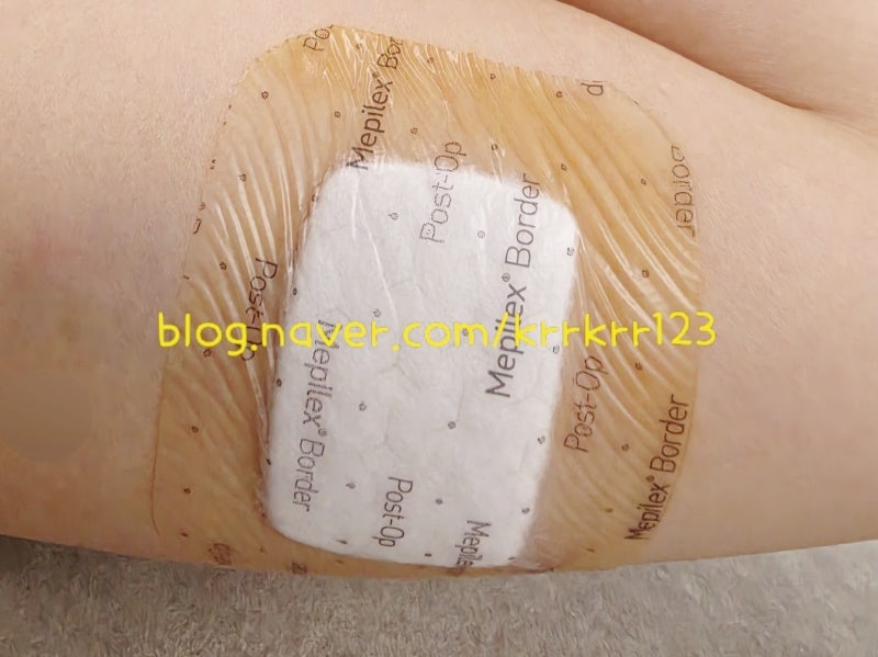 순천 광양 여수 임플라논 가격 시술 부작용 통증 실제 후기