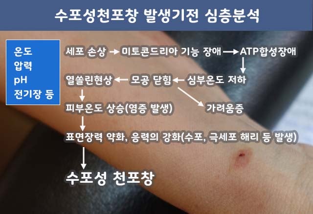 수포성 천포창 - 만성화되는 이유