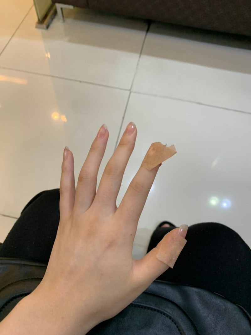 [사마귀냉동치료후기] 통증·물집·3주 회복과 4년째 재발 없는 기록