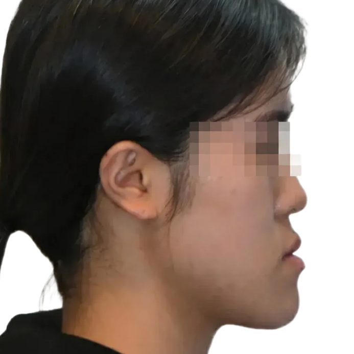 비수술 위해 주걱턱 교정 비용 2번 쓴 후기