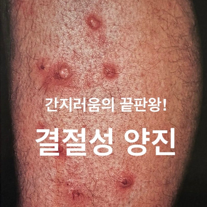 대구 결절성 양진 치료 증상 원인까지 장재원 피부과 의원