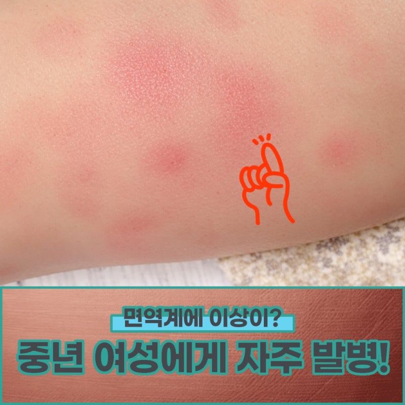 루프스 신염 이유 없는 거품뇨와 부종이 지속된다면?