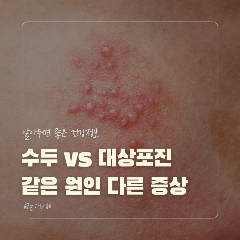 어릴 때 수두 걸렸다면 주목! 당신의 몸속에 대상포진이 숨어있는 이유