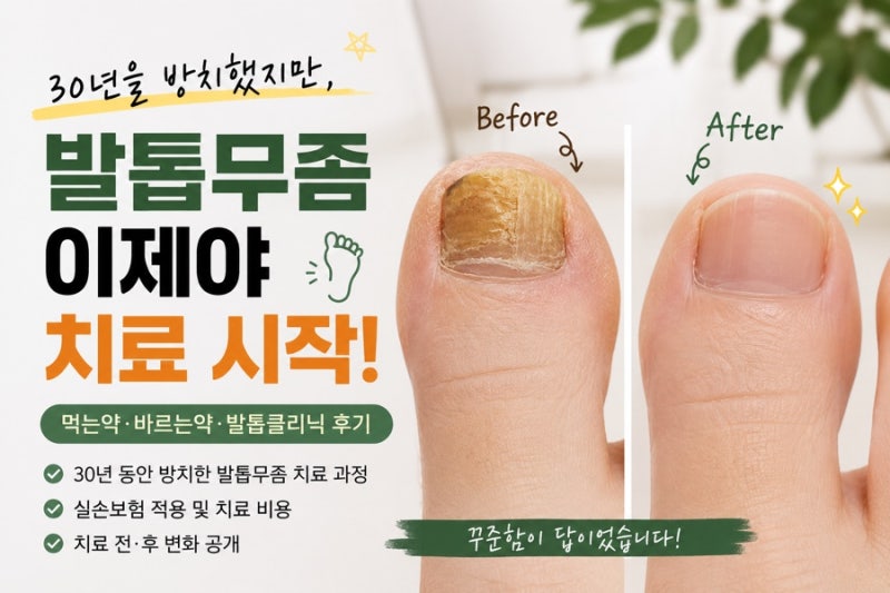 30년 동안 방치했던 발톱무좀, 먹는약, 바르는약 소용없었다! | 이제는 정말 치료하기로 했습....