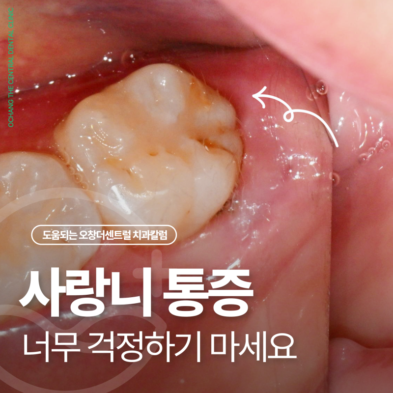 사랑니 잇몸 통증, 매복 사랑니 발치 전 확인할 5가지