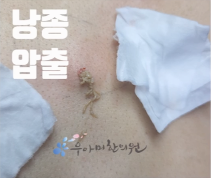 외음부 뾰루지, 생식기 종기로 번지면 흉터가 남을 수 있습니다