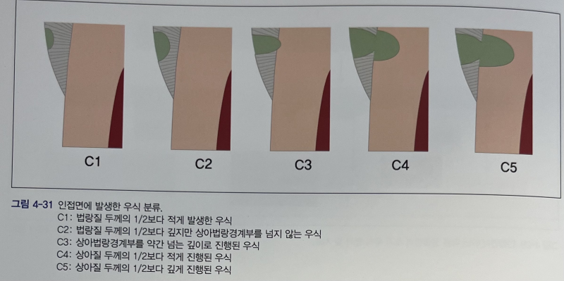 치아우식증의 분류