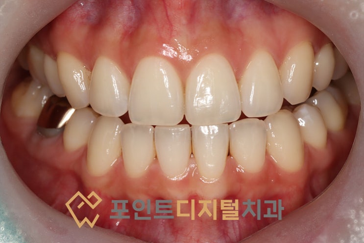 [탕정역 치과] 치아미백 쉐이드 변화! 미백폭발코스로 찾은 역대급 환한 미소(연예인 치아색 BL3) / 천안 아산