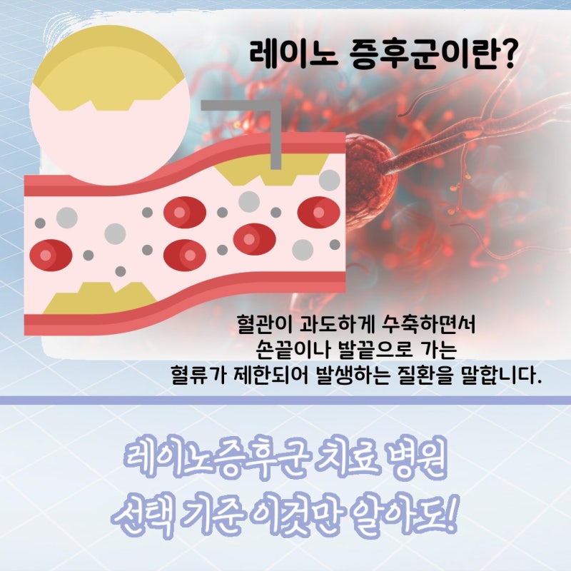 레이노증후군발바닥 시리고 저린 증상이 지속된다면?