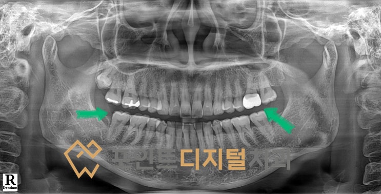 [탕정 치과] 