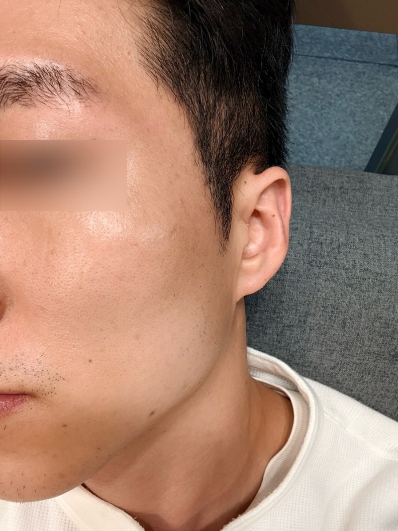 부천 편평사마귀 제거 무제한 / 듀오덤 붙이지 않아도 되는 쥐젖 비립종 편사 제거