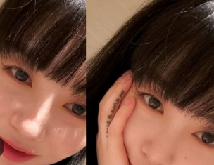 얼굴 화상으로 진물·물집까지…권민아, 슈링크 600샷 의료사고 5개월 만에 공개한 '진짜 얼굴....