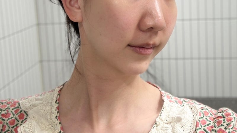 [노원 편평사마귀 제거치료] 거우침으로 눈꺼풀 부분도 싹! 솔직한 회복 후기