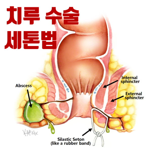 세톤법, 치루 수술 배액선법, 원리 과정 대상 장점