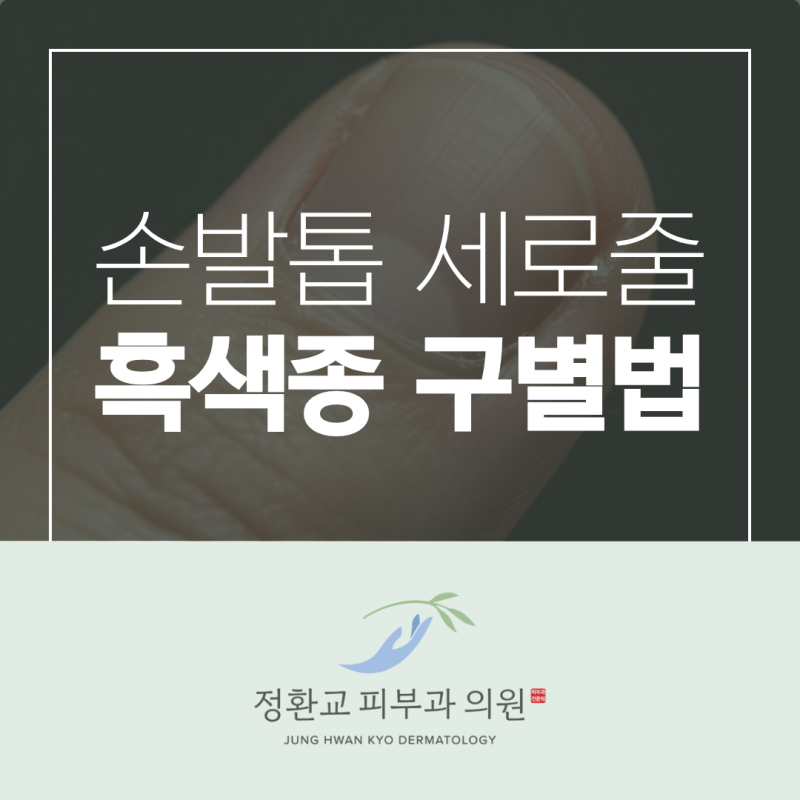 엄지손톱 세로줄 손발톱 검은선, 흑색종 자가점검 및 치료법