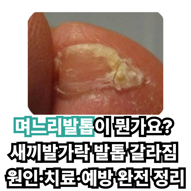 며느리발톱이 뭔가요? 새끼발가락 발톱 갈라짐 원인·치료·예방 완전 정리