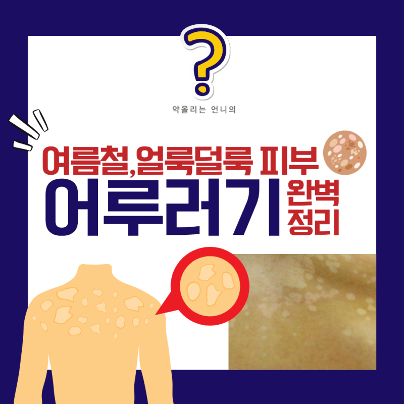 여름철 얼룩덜룩 피부, 어루러기 완벽정리 (무좀약 발라도 안 낫는 이유부터, 백반증과 헷갈....
