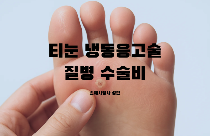 티눈 냉동응고술 수술비 보험금: 2026년 최신 대법원 판례로 바뀐 지급기준은?