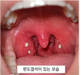 입에서 나오는 노란 알갱이의 정체! 편도결석 원인부터 안전한 제거법, 의외의 유발 습관 총....