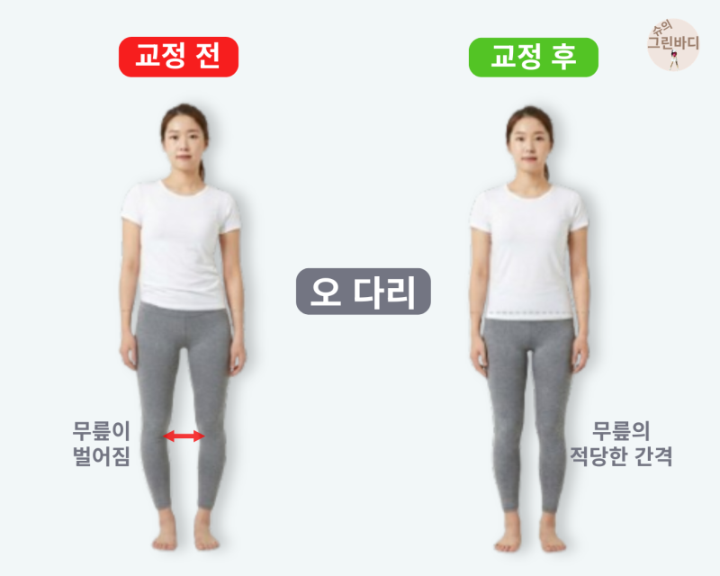 오다리, 오자다리, 내반슬 방치하면 무릎이 망가질 수 있습니다! 원인부터 교정운동까지 총....