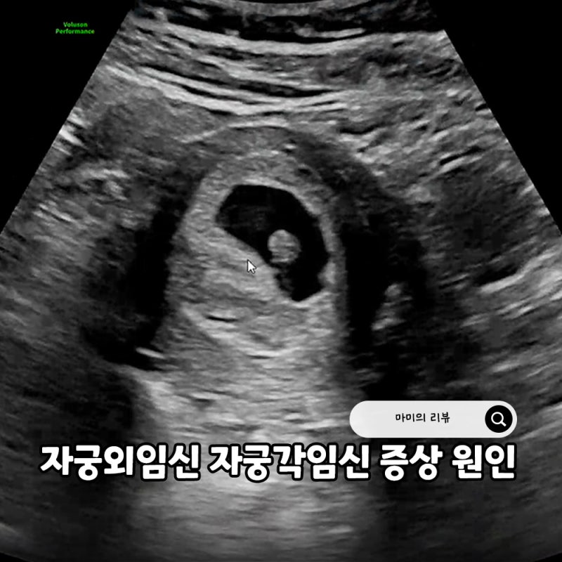 자궁외임신 자궁각임신 증상과 원인 확률 5주차 자궁각 임신 의심소견